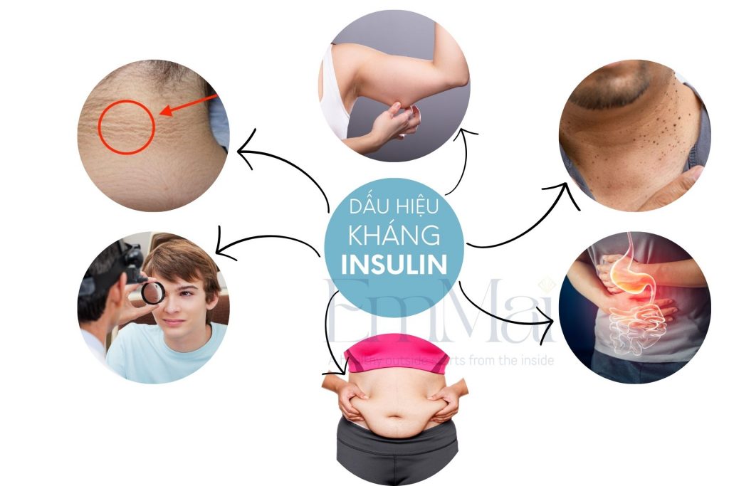Một số triệu chứng của kháng insulin và tiền tiểu đường